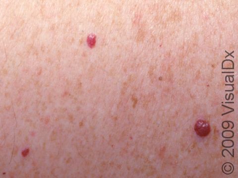 This close-up of 3 cherry hemangiomas shows their typical red color and round shape.