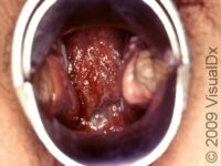 Chlamydial Infections – Adult