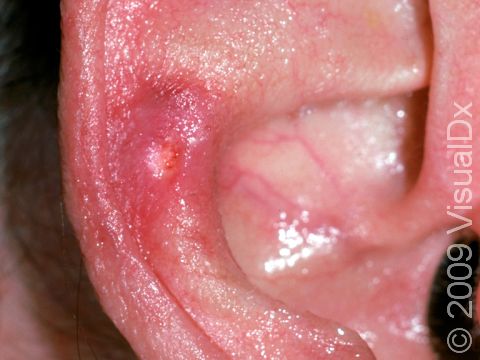 Chondrodermatitis nodularis can involve the cartilage and skin of the ear, as displayed in this image.