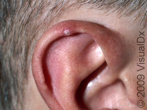 Typical to chondrodermatitis nodularis helicis, there is a very tender, small nodule at the rim of the ear.