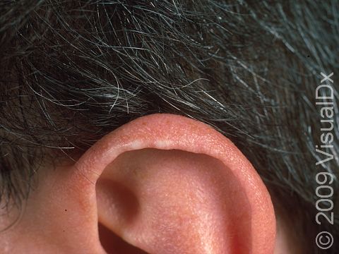 This image displays small elevations of the skin at the rim of the ear.