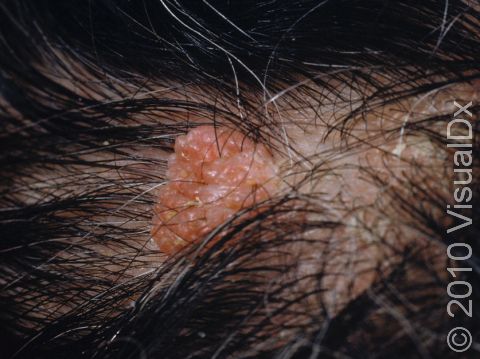 This is a nevus (mole) in the scalp.