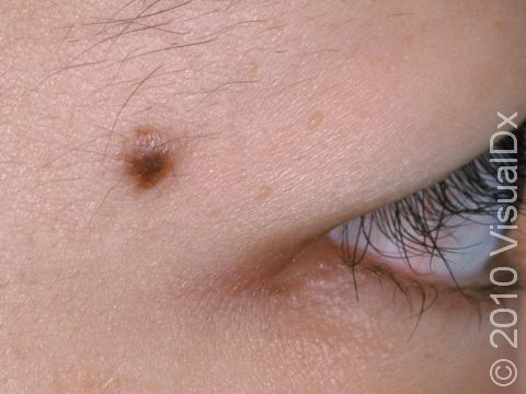 This is a benign mole (nevus). Note the consistent color.
