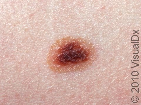 This image displays a normal nevus (mole).