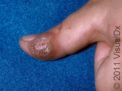 This image displays a large wart on the thumb.