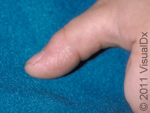 This image displays the area of a healed wart.