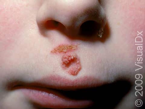 This child has two warts: one near the left nostril and another doughnut-shaped one above the upper lip. The scratch above the wart on the lip could be the entry point for the infection.