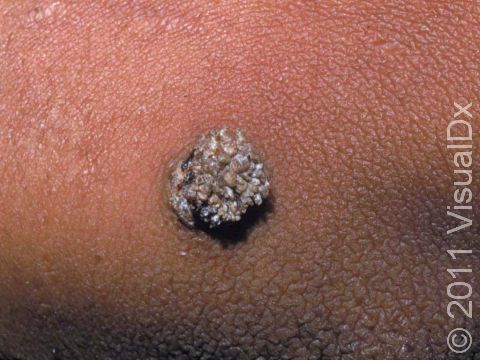 This image displays a wart that is made up of many scaly skin projections.