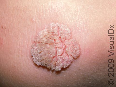 As displayed in this image, warts often have a rough, cracked appearance.