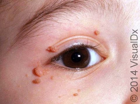 This image displays common warts on the face, most likely from transferring the wart virus from the child's fingers.