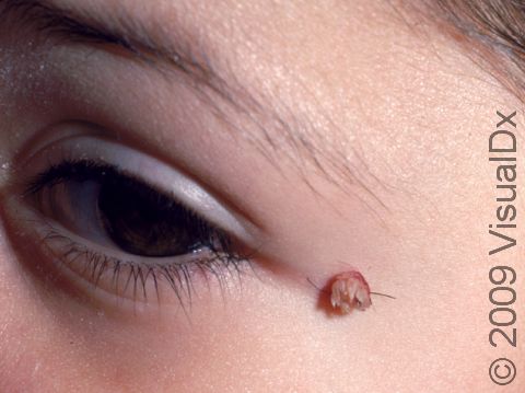 Warts often have a rough, multi-pointed surface, like this wart near the eye.