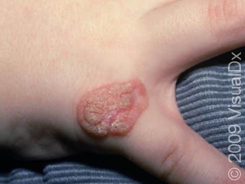 This image displays the thick and rough surface typical of a wart.