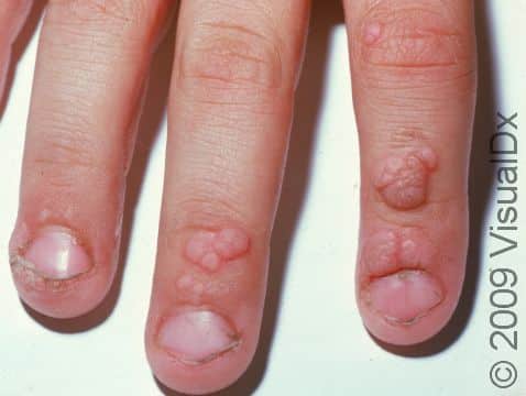 In children whose immune systems have not yet recognized the wart infection, lesions may be numerous and even form around and under the nails.