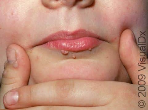 This image displays two spider angiomas on the upper lip.