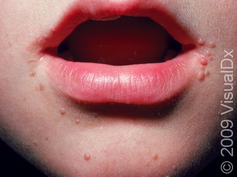 Multiple warts are seen at the left mouth angle as well as on the chin.