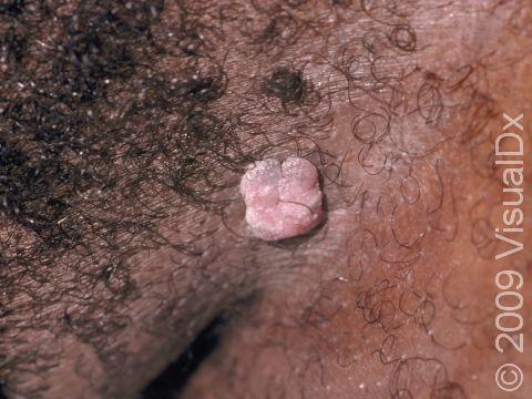 Genital warts (condyloma), can appear anywhere in the genital region.