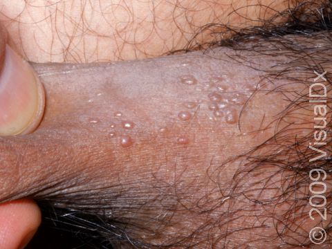 This image displays multiple small condylomas (genital warts) on the shaft of the penis.