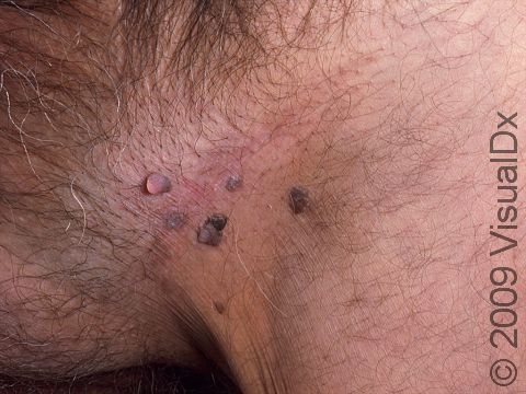 This image displays condyloma (genital warts) on the groin.