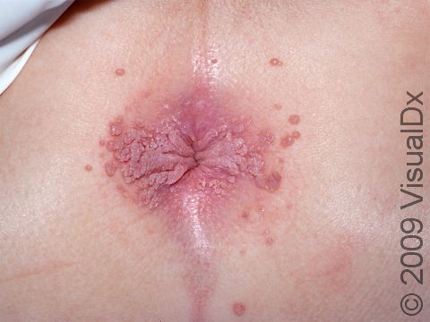 This image displays condyloma acuminatum (anal warts) on the anus and rectum.