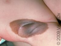 Birthmark (Congenital Melanocytic Nevus)