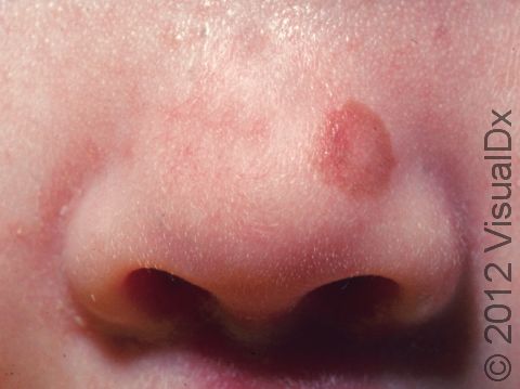 A congenital nevus is found in about 2% of newborns and is usually a raised, brown spot, as seen here on the nose.