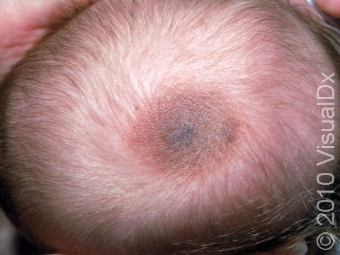 This image displays color and darker pigment typical of a congenital melanocytic nevus.