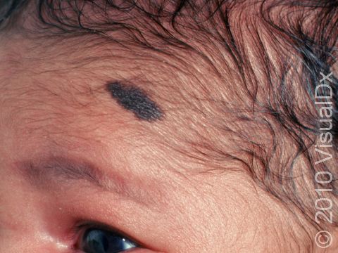 Congenital melanocytic nevi are present at birth.
