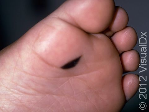 A congenital nevus on the sole or palm often has a flat appearance and may be brown to almost black in color.