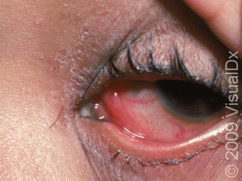 Viral conjunctivitis can cause redness and tearing of the eye.