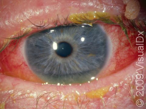 This is the most typical appearance of conjunctivitis with redness of the eye and mucoid debris on the eyelashes.