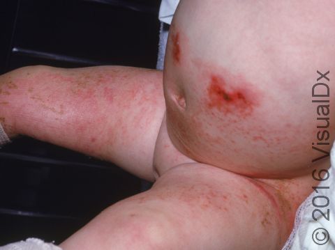This hospitalized infant had an allergic contact dermatitis involving the legs and abdomen.