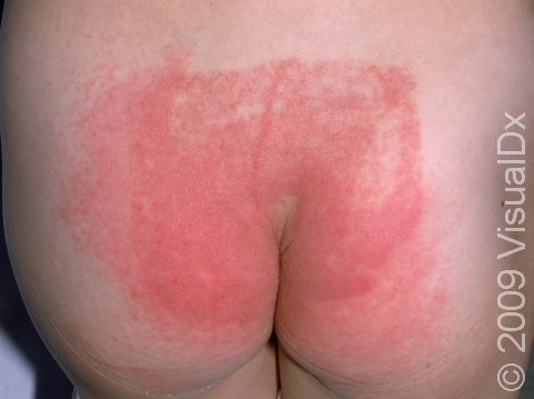 This image displays a red patch of contact dermatitis on the buttocks.