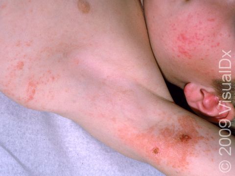 Contact dermatitis can have multiple areas of skin involvement.