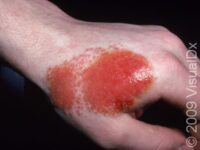 Allergic Contact Dermatitis (Pediatric)