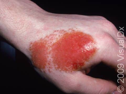 Allergic contact dermatitis is marked by redness, swelling, and itching.