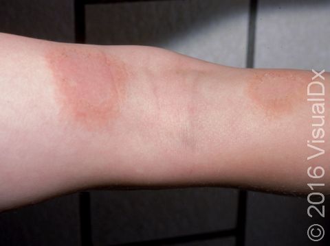 This image displays the scaling, slightly raised lesions typical of allergic contact dermatitis in a child.