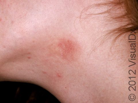 This image displays fiddler's neck, contact dermatitis from a violin.