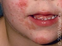 Allergic Contact Dermatitis (Pediatric)