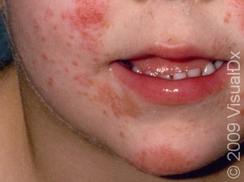 Contact dermatitis, though rare, can be caused by allergic skin reactions in infants and children.