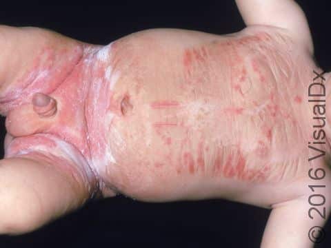 An allergic contact dermatitis is usually worse than an irritant diaper rash; this baby has blisters from a severe reaction to a diaper ointment.