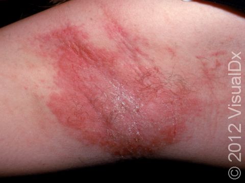 This image displays allergic contact dermatitis from fragrance found in a deodorant.