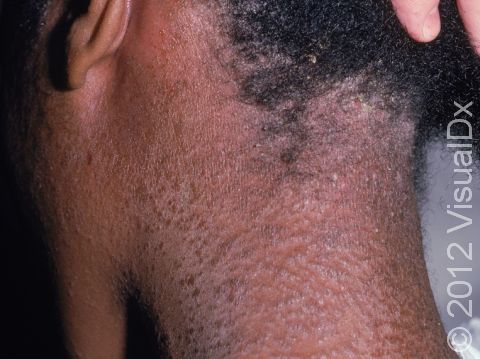 This teenager was using a hair care product that caused an allergic contact dermatitis.