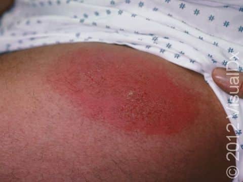 This image displays a pink, itchy, scaly lesion due to an allergy to fragrance in a skin care product.