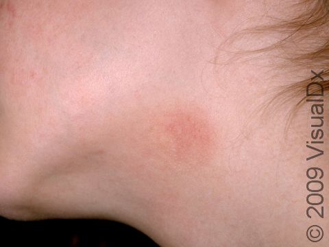 This image displays contact dermatitis, also called 