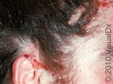This image displays contact dermatitis on the scalp and adjacent to the scalp area in a young man who was using a hair straightener.