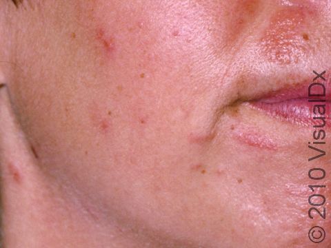 This woman had an allergy to a cosmetic. Note the pink areas at the chin and upper lip.