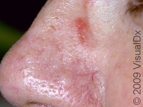This image displays a scaly, slightly elevated lesion due to an allergy to the nickel in an eyeglass frame.