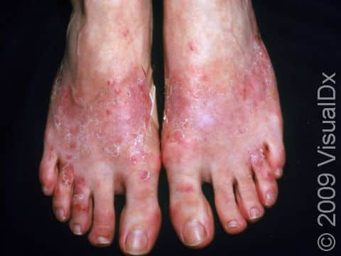 This image displays allergic contact dermatitis on the top of the feet.