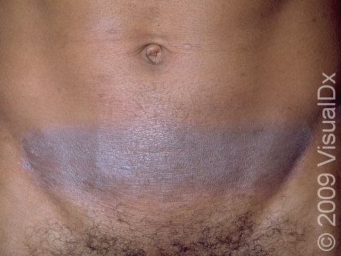 This image displays a violet-colored, linear, slightly elevated lesion typical of contact dermatitis, due to an allergy to the rubber in the elastic waistband of the patient's underwear.