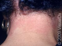 Allergic Contact Dermatitis